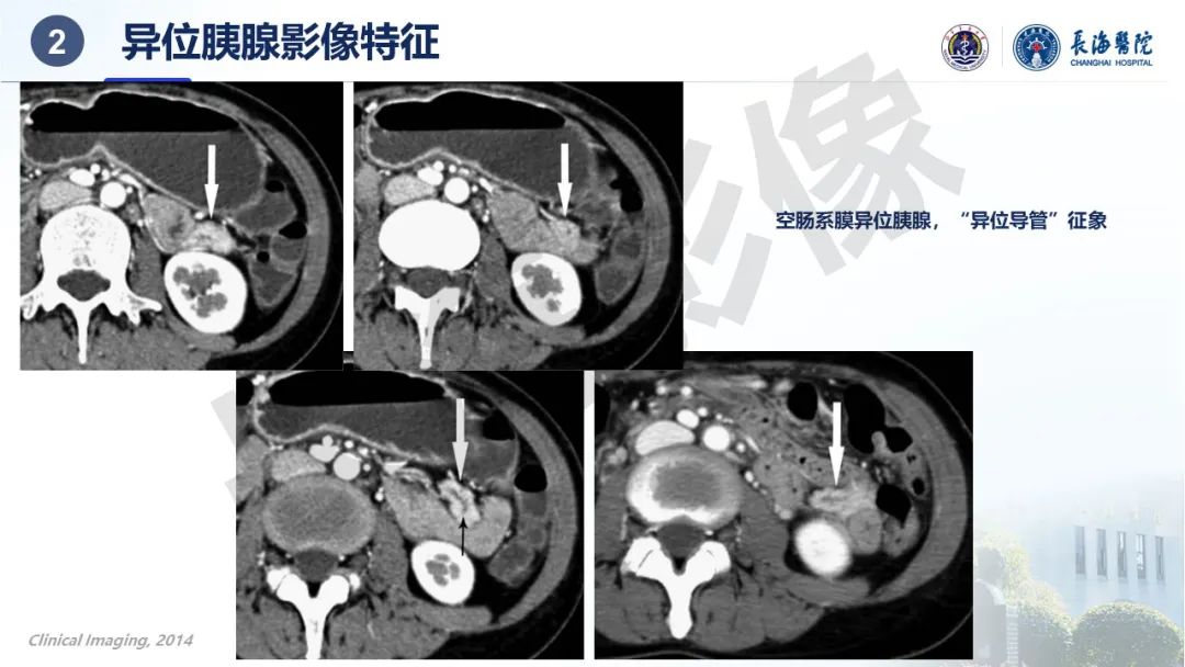 影像PPT - 【PPT】异位胰腺的影像特征及并发症-12