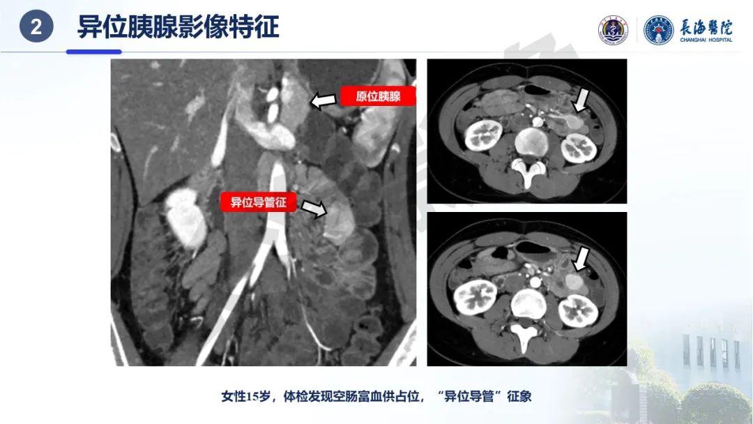 影像PPT - 【PPT】异位胰腺的影像特征及并发症-13
