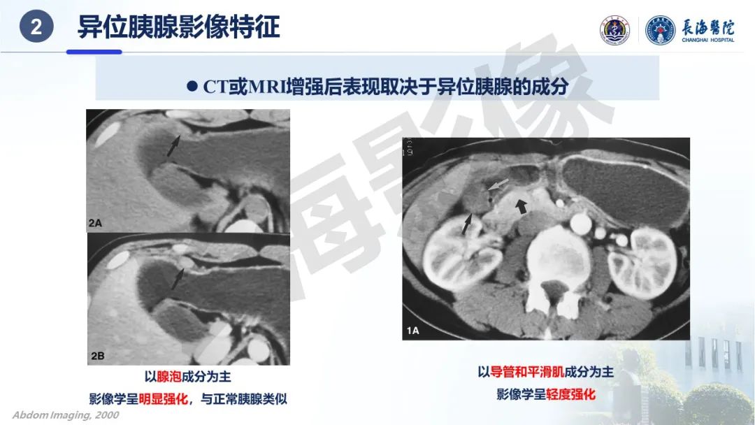 影像PPT - 【PPT】异位胰腺的影像特征及并发症-14