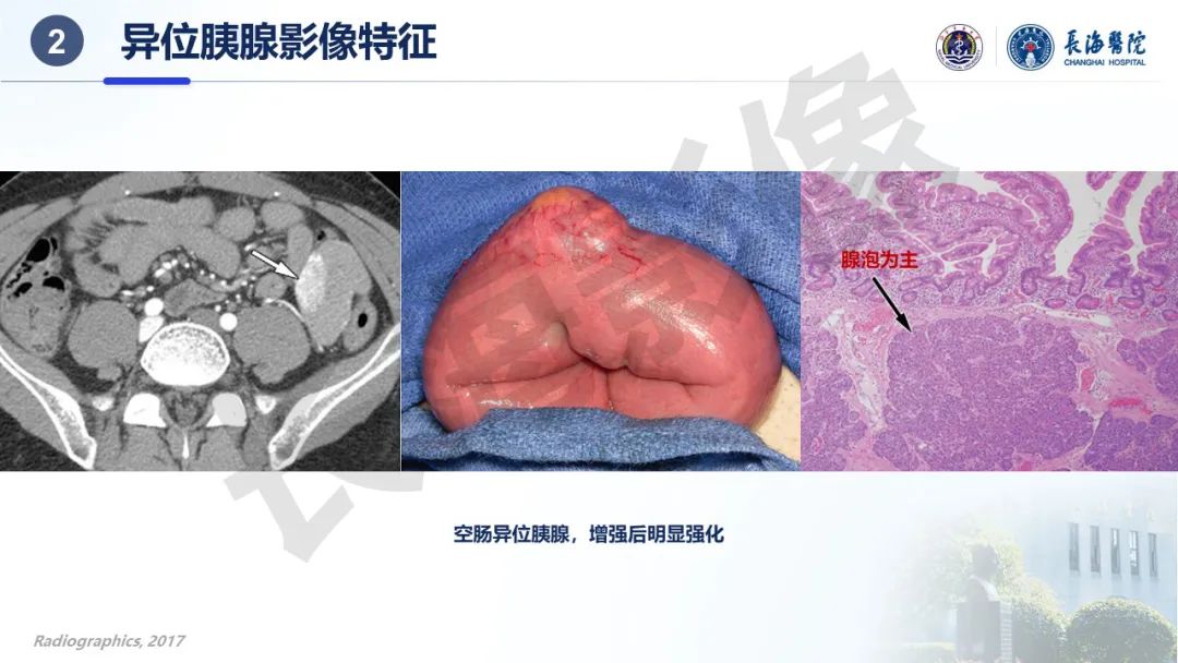 影像PPT - 【PPT】异位胰腺的影像特征及并发症-15