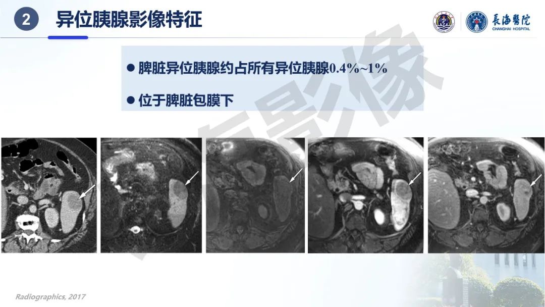 影像PPT - 【PPT】异位胰腺的影像特征及并发症-16