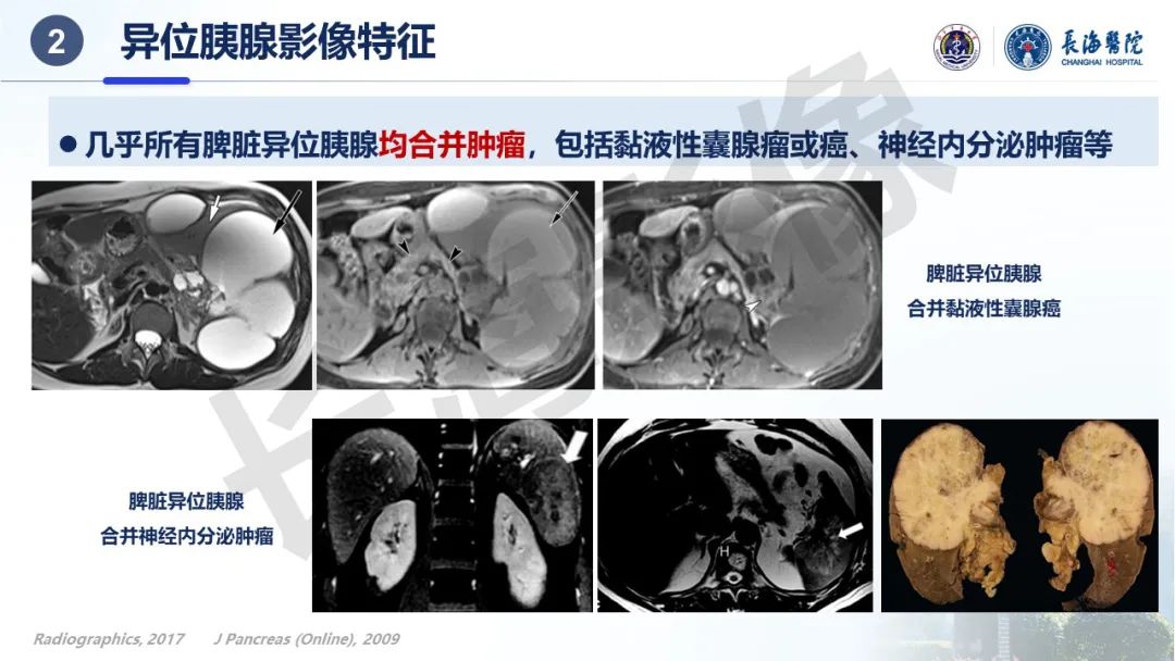 影像PPT - 【PPT】异位胰腺的影像特征及并发症-17