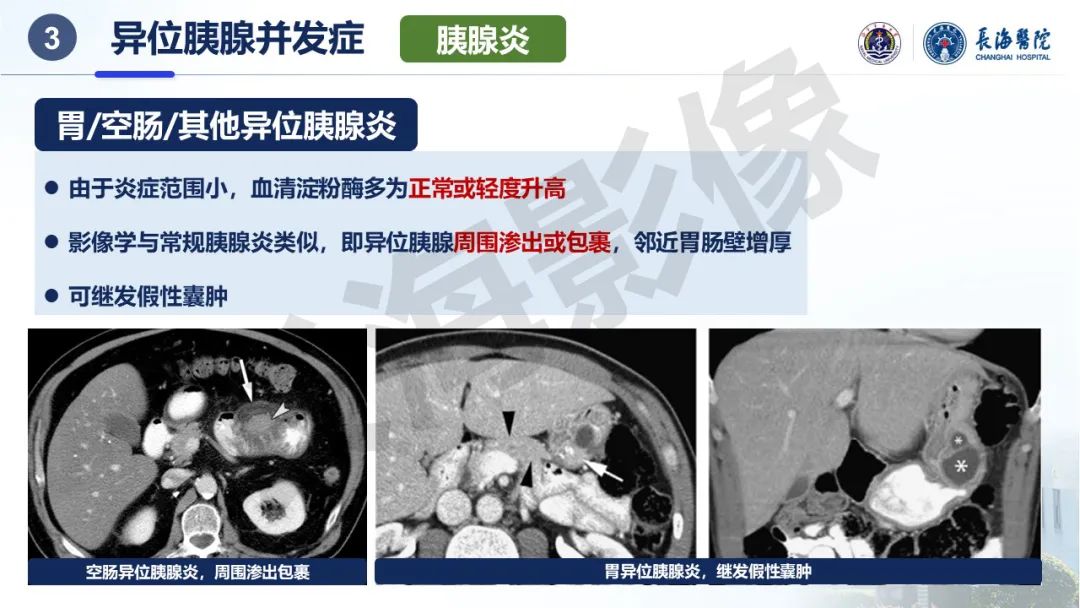 影像PPT - 【PPT】异位胰腺的影像特征及并发症-21