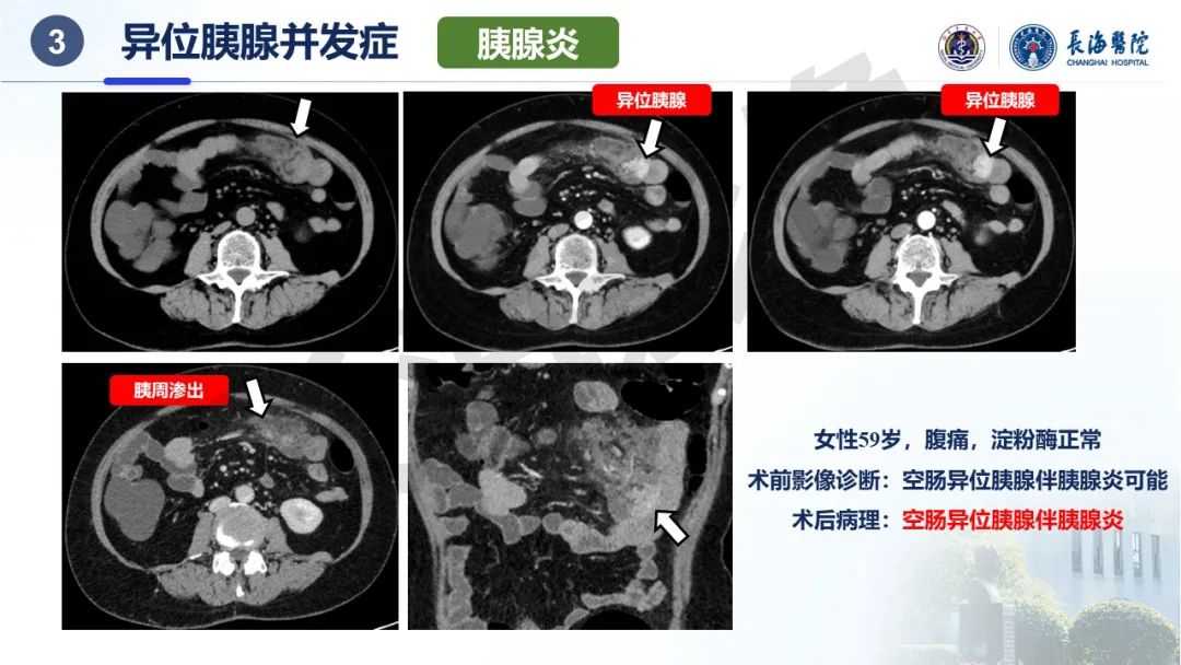 影像PPT - 【PPT】异位胰腺的影像特征及并发症-22