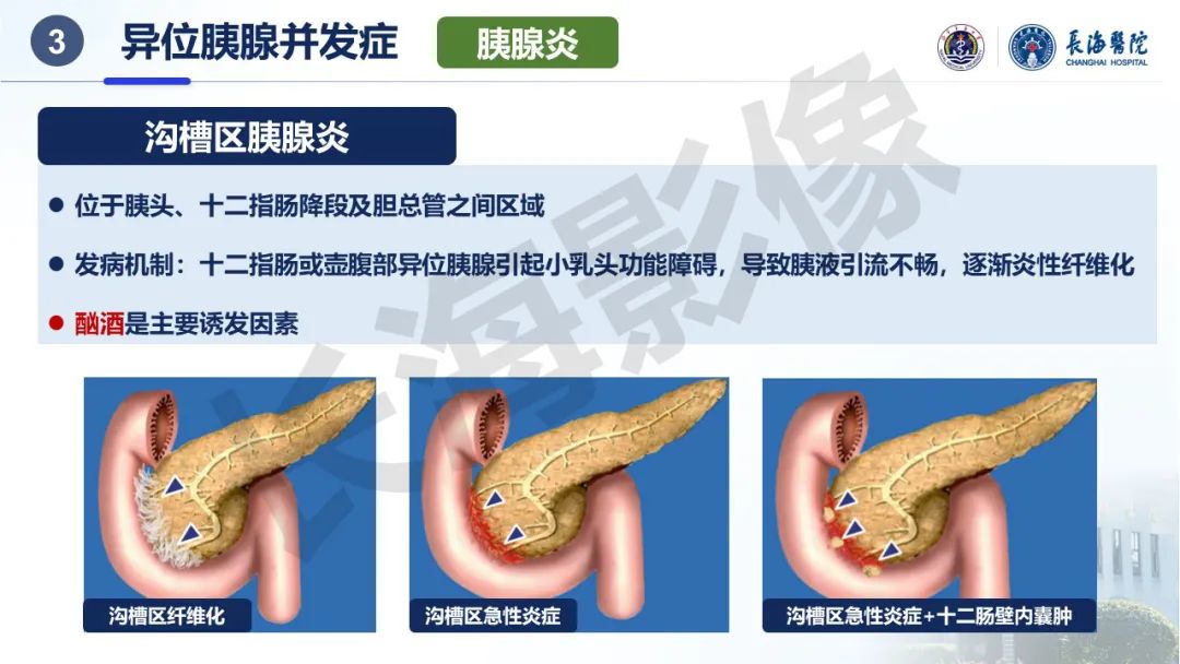 影像PPT - 【PPT】异位胰腺的影像特征及并发症-23