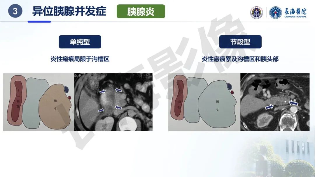 影像PPT - 【PPT】异位胰腺的影像特征及并发症-24