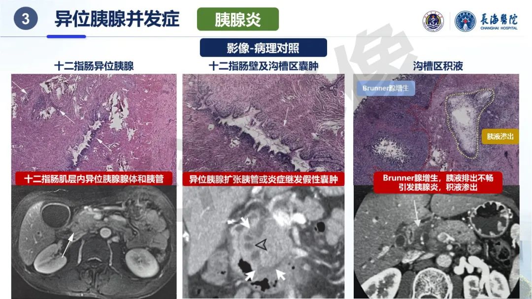 影像PPT - 【PPT】异位胰腺的影像特征及并发症-25