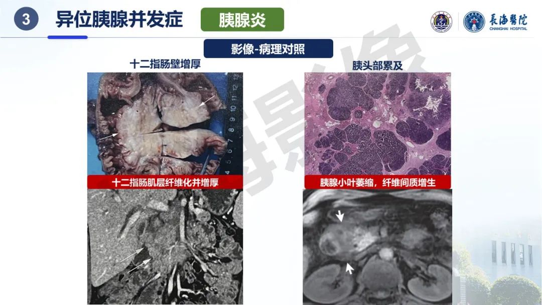 影像PPT - 【PPT】异位胰腺的影像特征及并发症-26