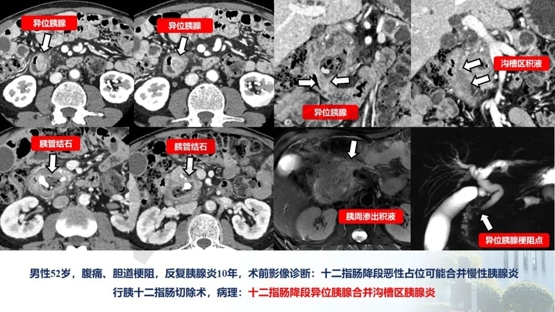 影像PPT - 【PPT】异位胰腺的影像特征及并发症-27