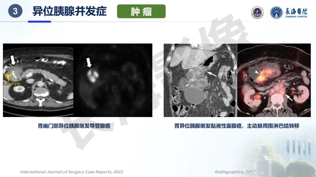 影像PPT - 【PPT】异位胰腺的影像特征及并发症-30