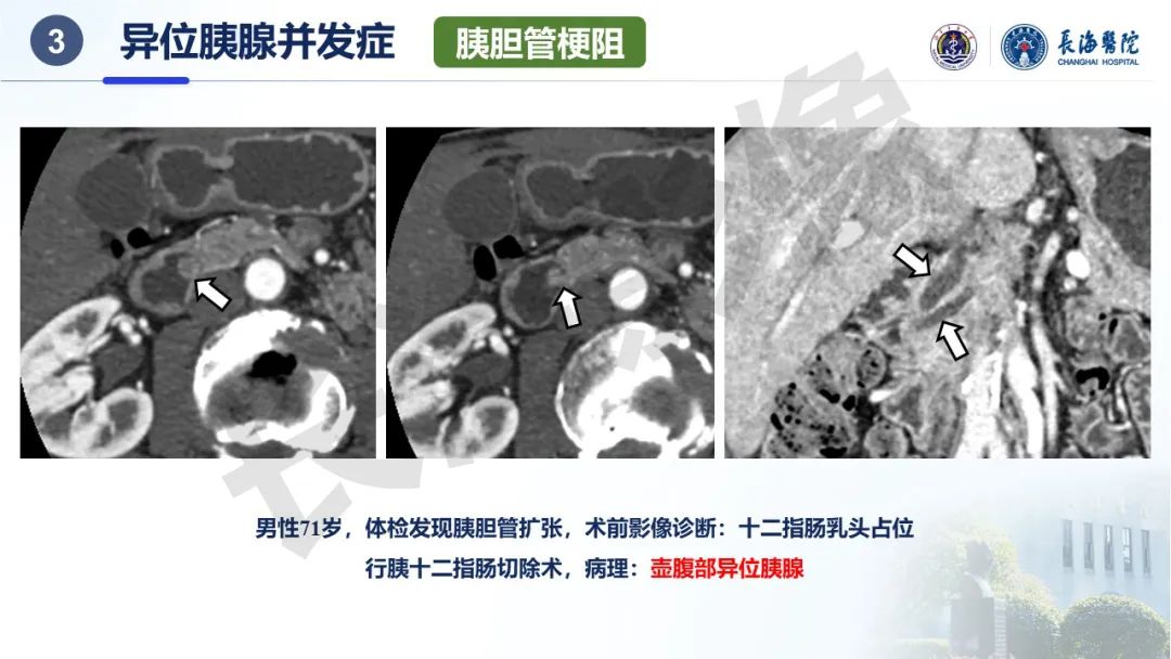 影像PPT - 【PPT】异位胰腺的影像特征及并发症-32
