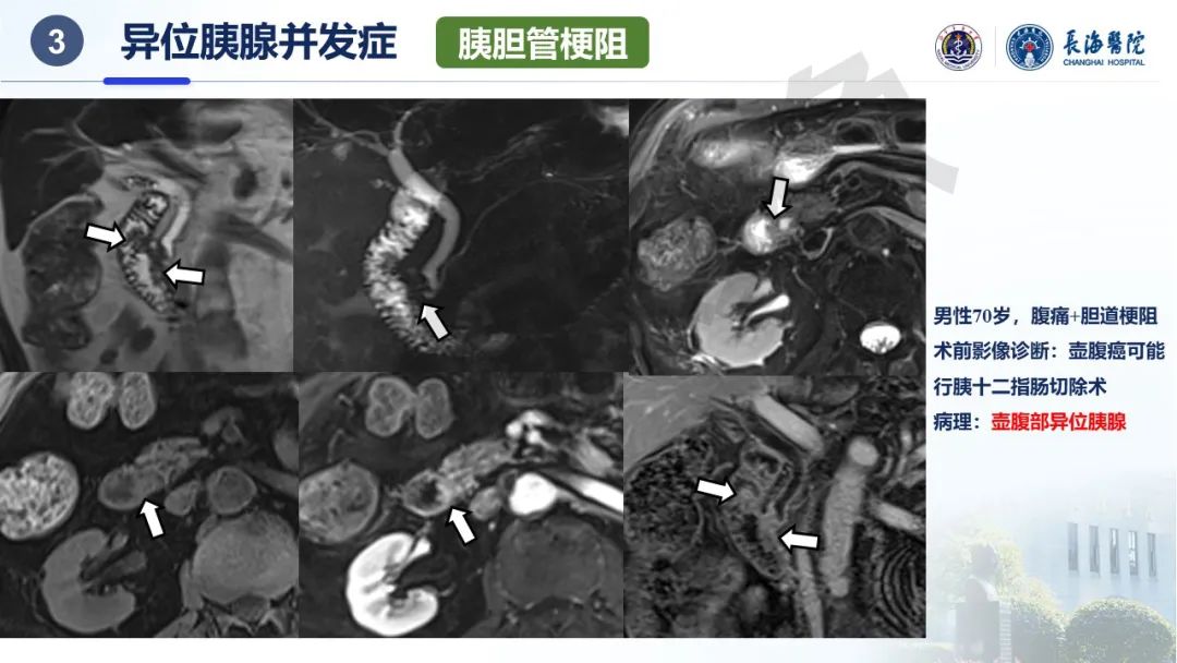 影像PPT - 【PPT】异位胰腺的影像特征及并发症-33