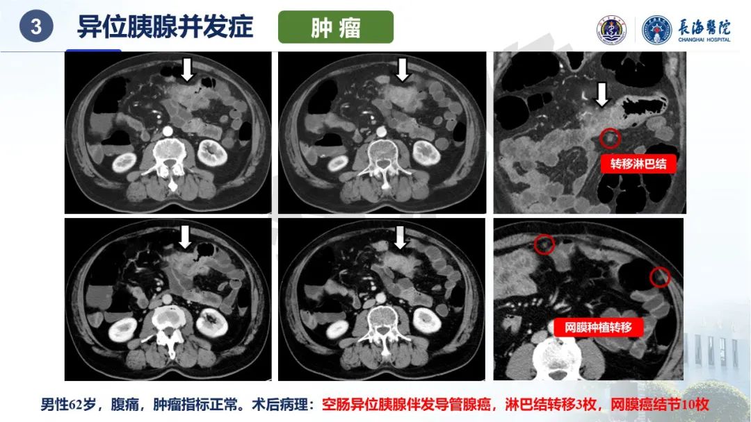 影像PPT - 【PPT】异位胰腺的影像特征及并发症-31