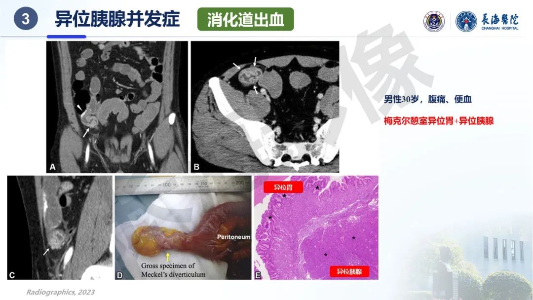 影像PPT - 【PPT】异位胰腺的影像特征及并发症-34