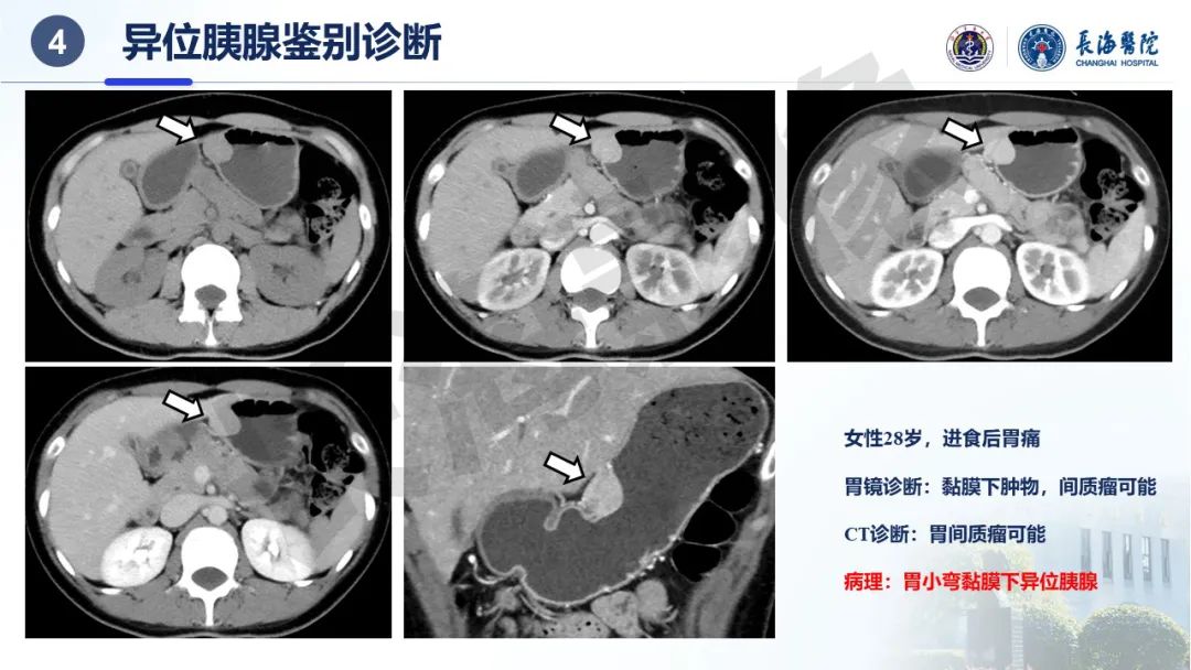 影像PPT - 【PPT】异位胰腺的影像特征及并发症-36