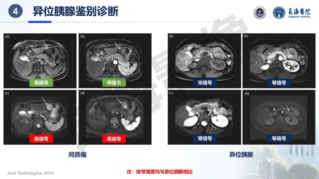 影像PPT - 【PPT】异位胰腺的影像特征及并发症-38