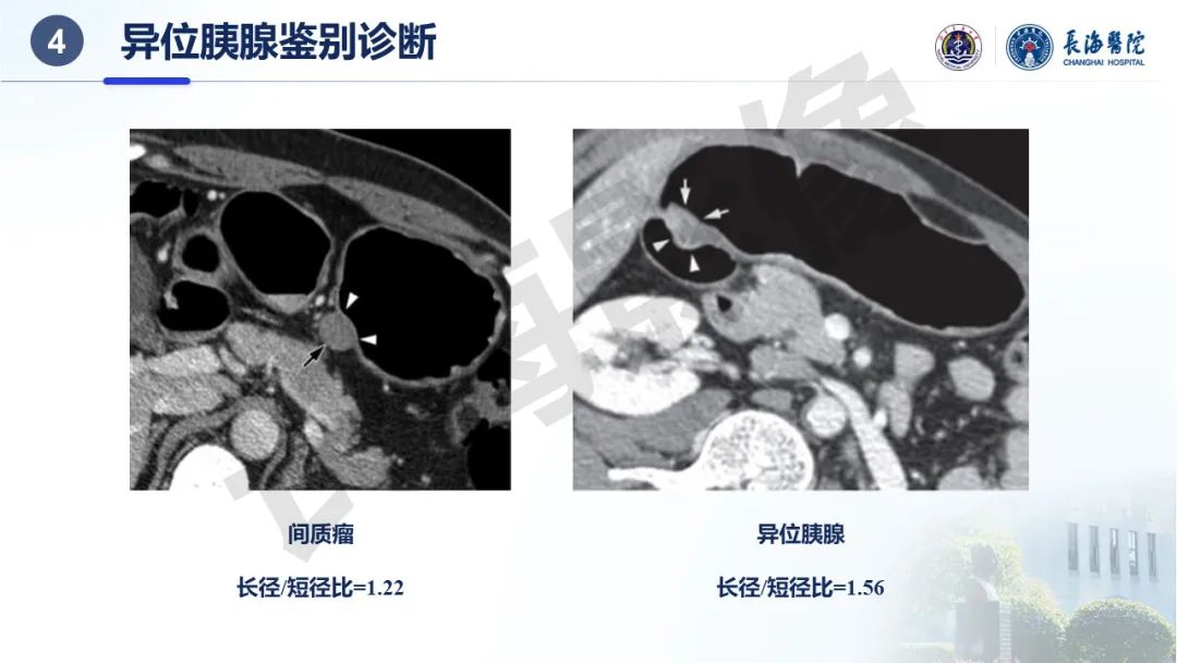 影像PPT - 【PPT】异位胰腺的影像特征及并发症-40