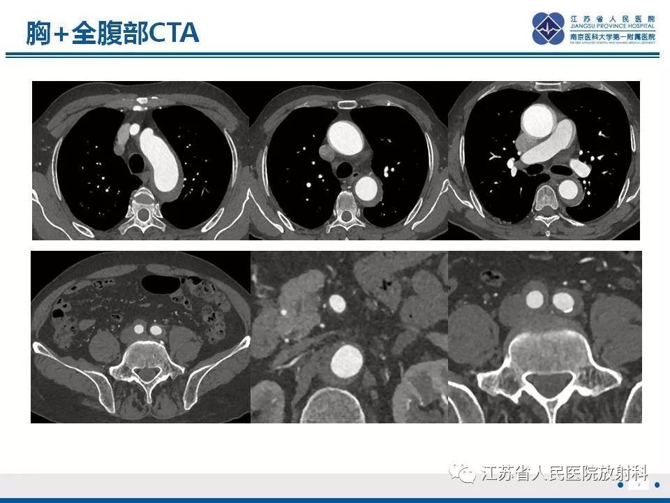 影像PPT - 【PPT】主动脉壁间血肿-3