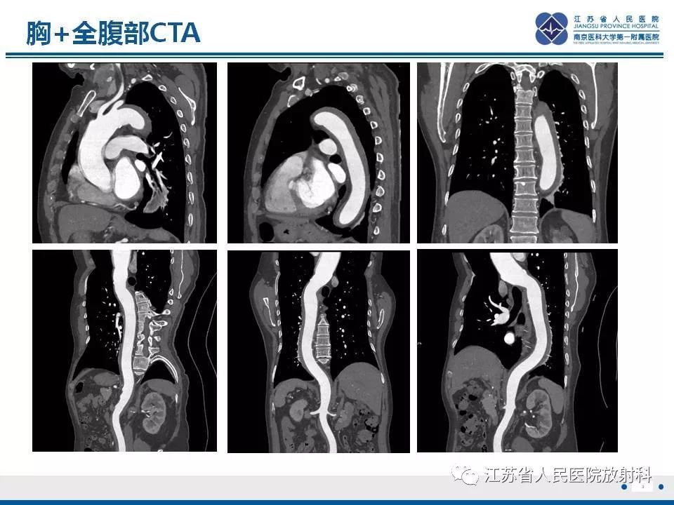 影像PPT - 【PPT】主动脉壁间血肿-4