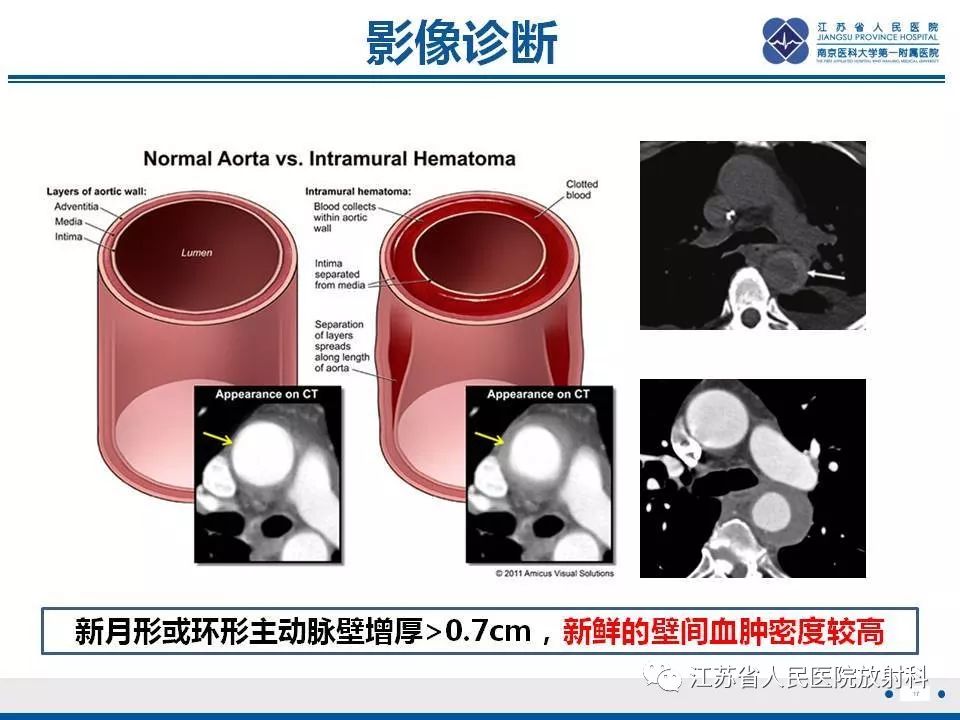 影像PPT - 【PPT】主动脉壁间血肿-18