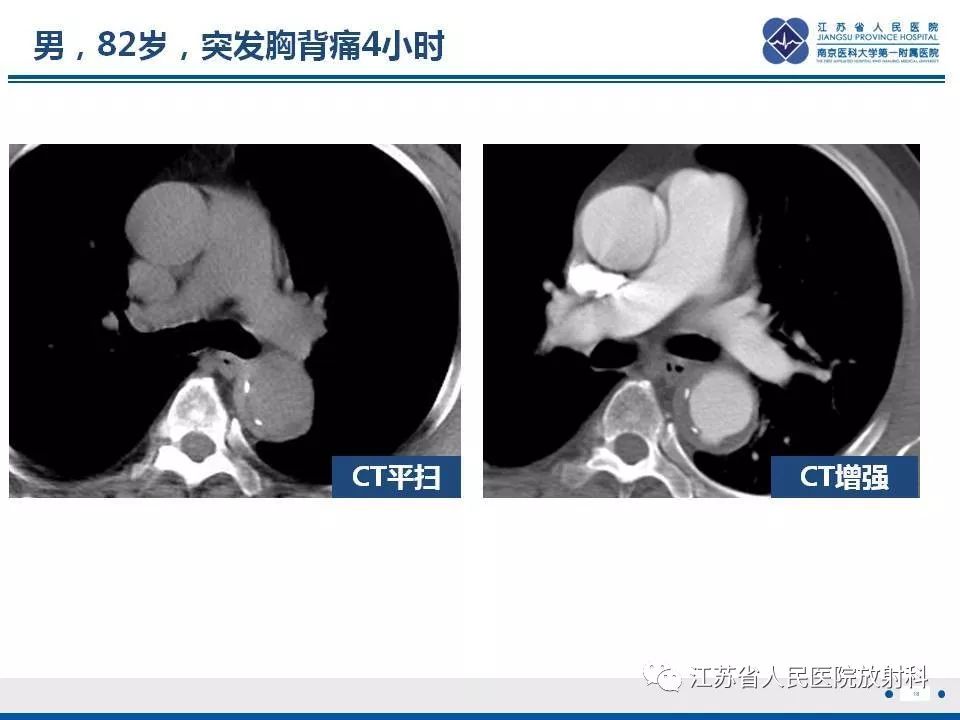 影像PPT - 【PPT】主动脉壁间血肿-19