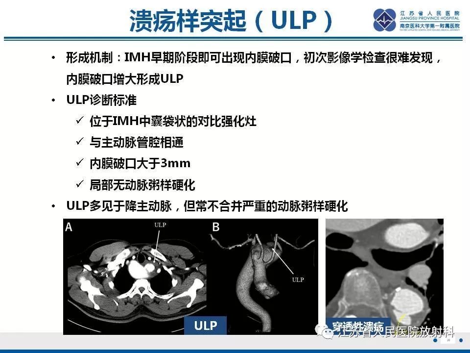 影像PPT - 【PPT】主动脉壁间血肿-21