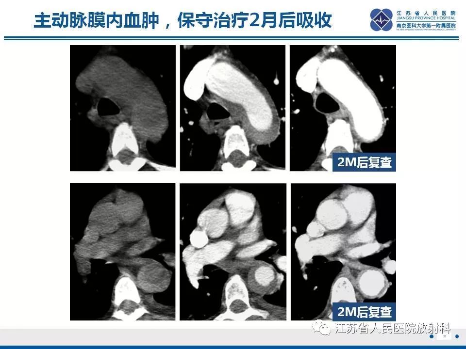 影像PPT - 【PPT】主动脉壁间血肿-24