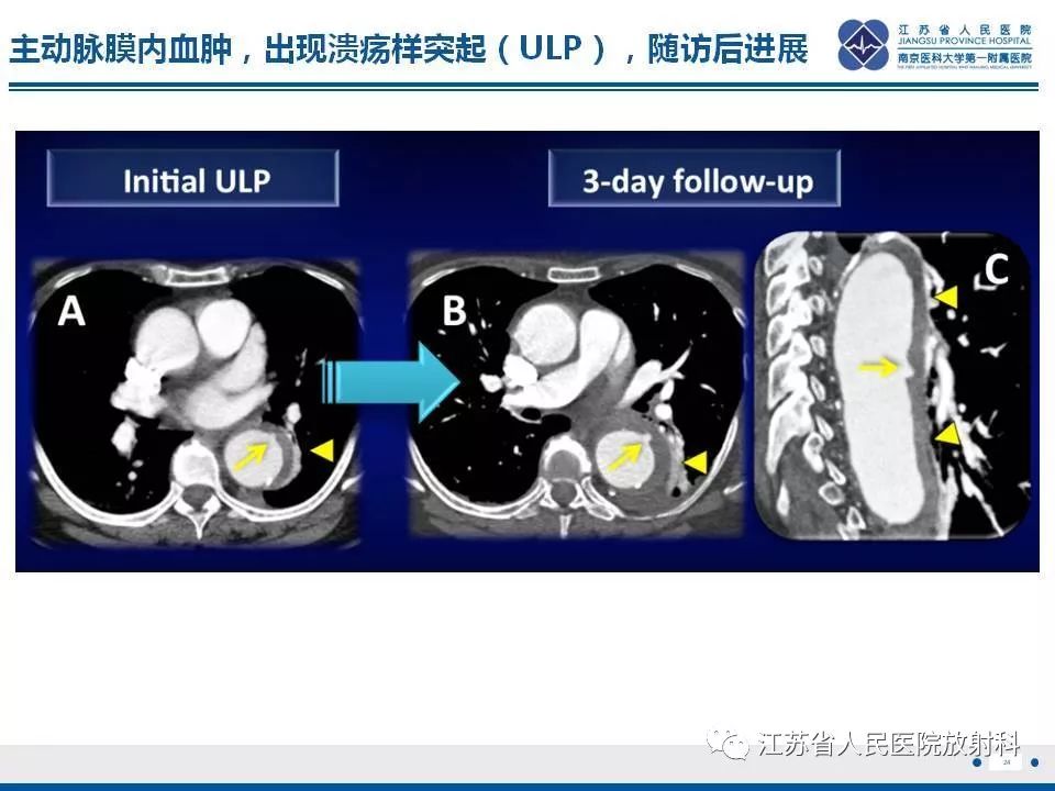 影像PPT - 【PPT】主动脉壁间血肿-25