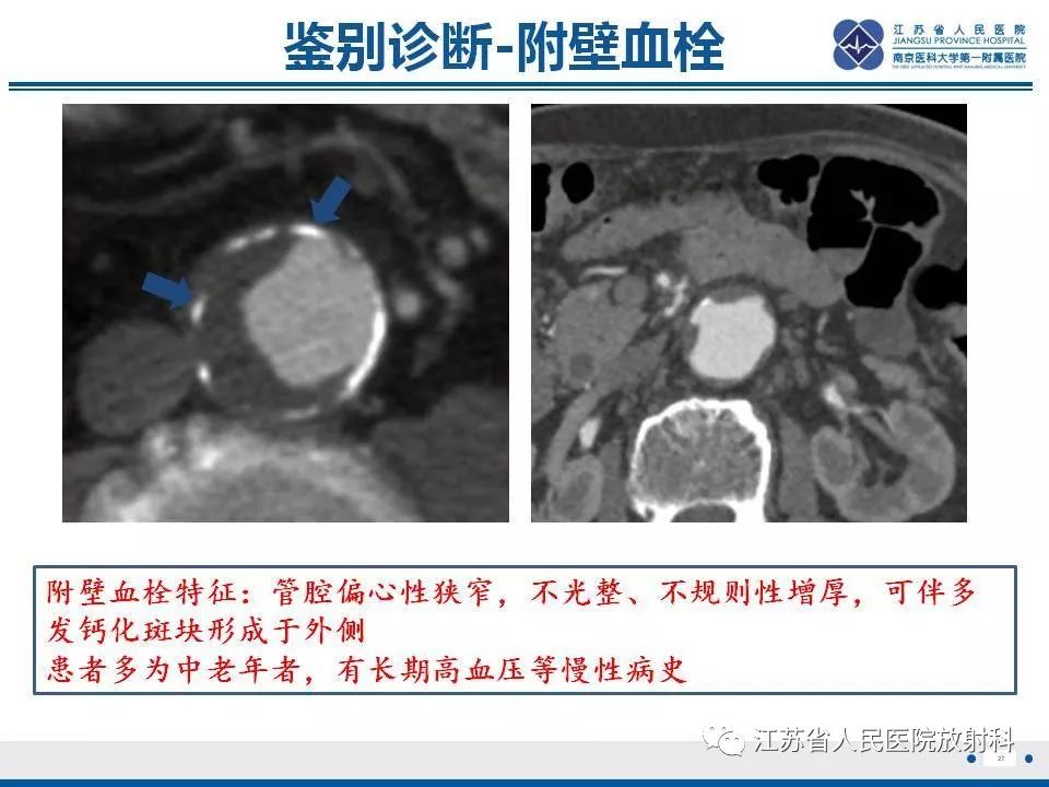影像PPT - 【PPT】主动脉壁间血肿-28