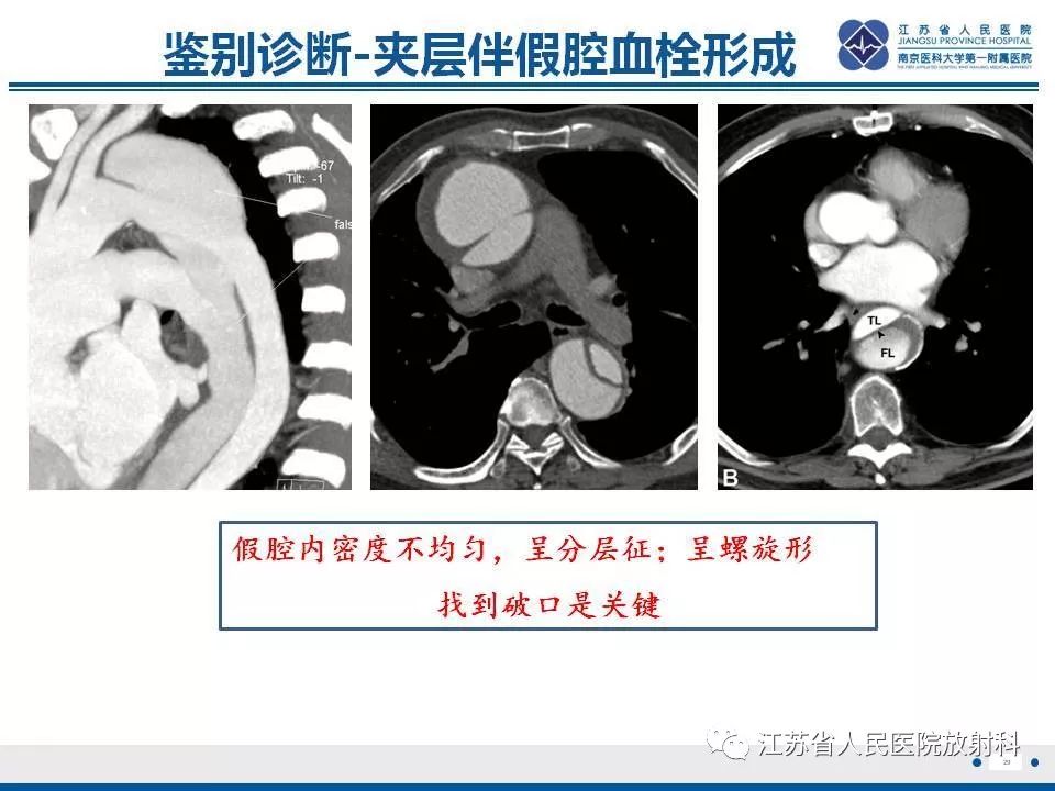 影像PPT - 【PPT】主动脉壁间血肿-30