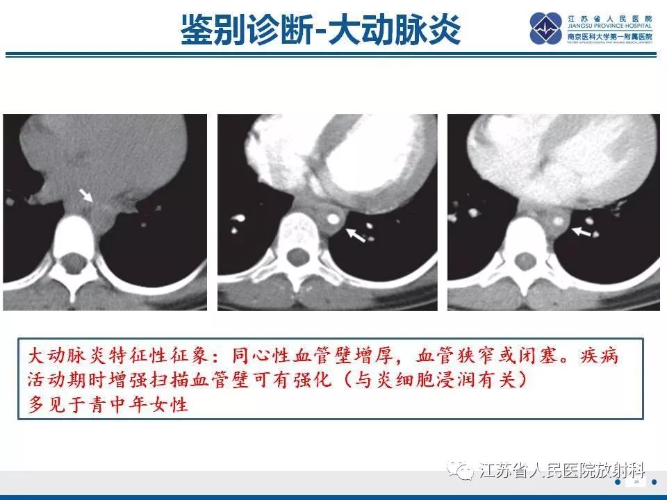 影像PPT - 【PPT】主动脉壁间血肿-29