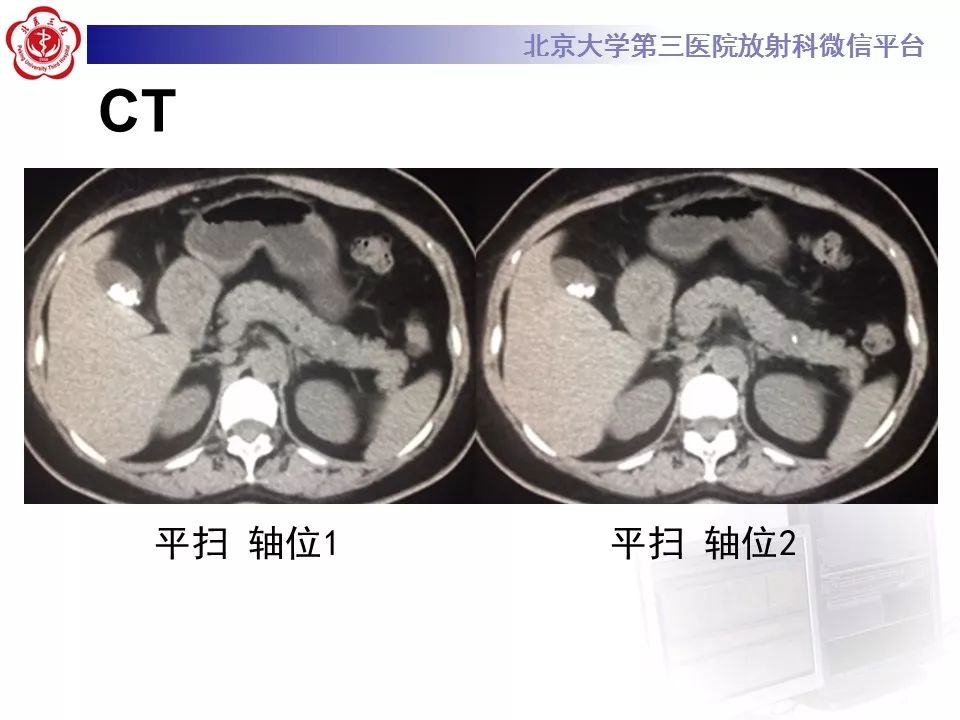 影像PPT - 【PPT】胰腺实性假乳头状肿瘤-3