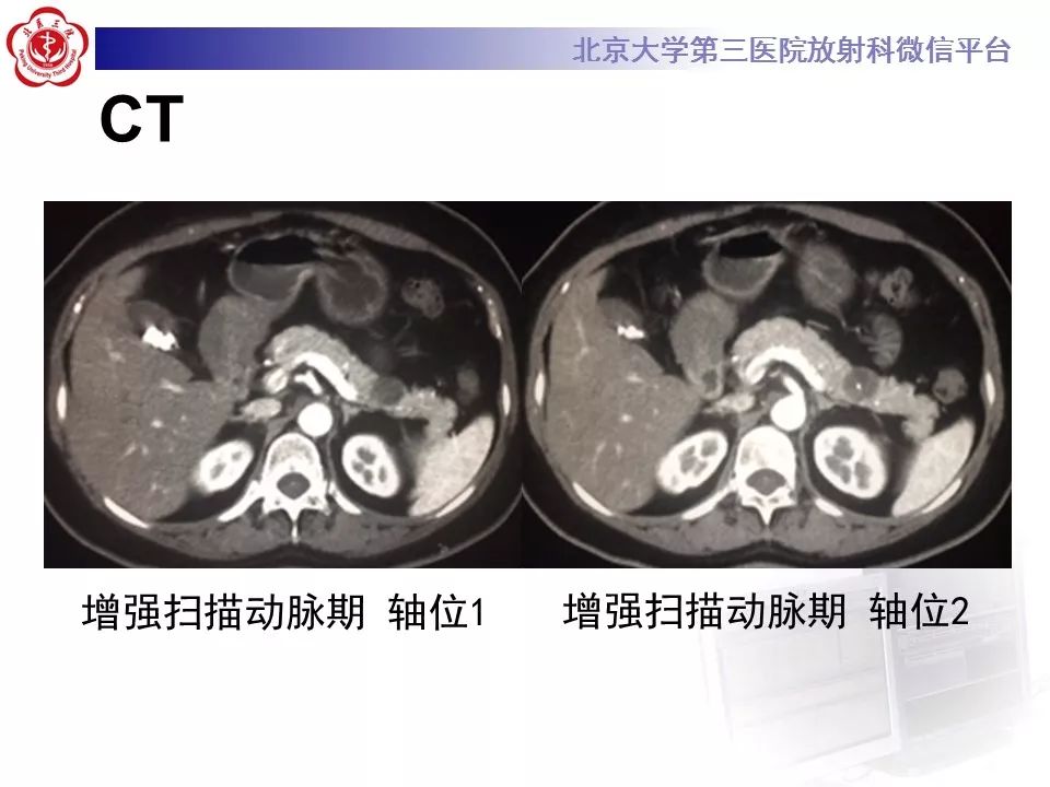 影像PPT - 【PPT】胰腺实性假乳头状肿瘤-4