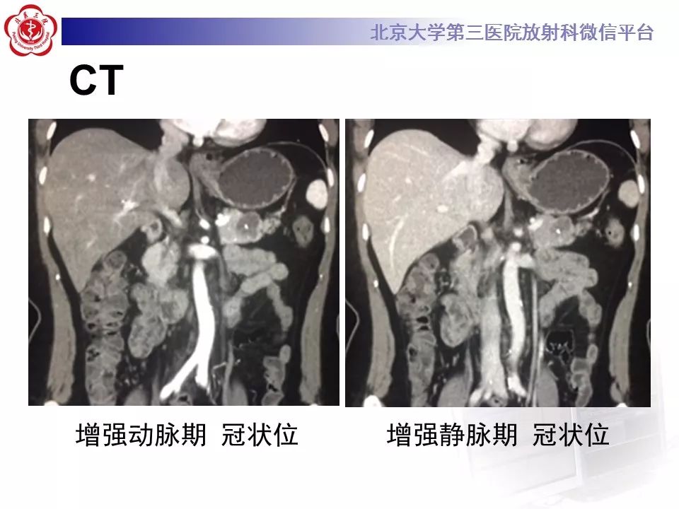 影像PPT - 【PPT】胰腺实性假乳头状肿瘤-6