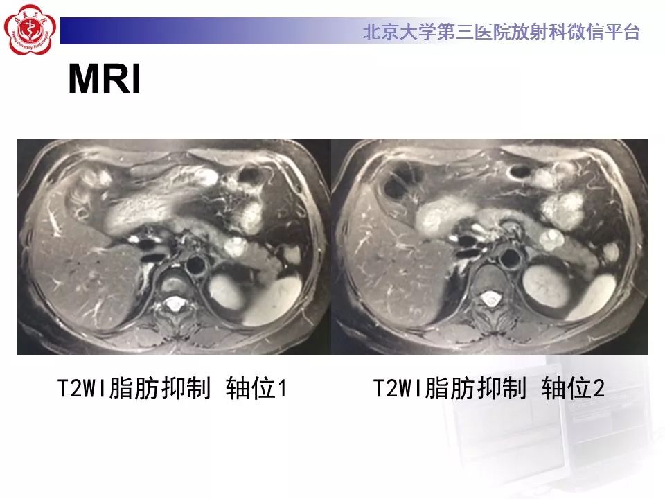 影像PPT - 【PPT】胰腺实性假乳头状肿瘤-10