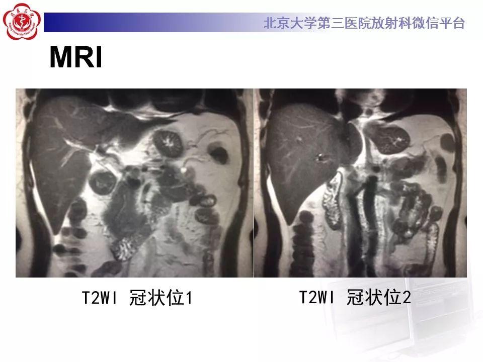 影像PPT - 【PPT】胰腺实性假乳头状肿瘤-11