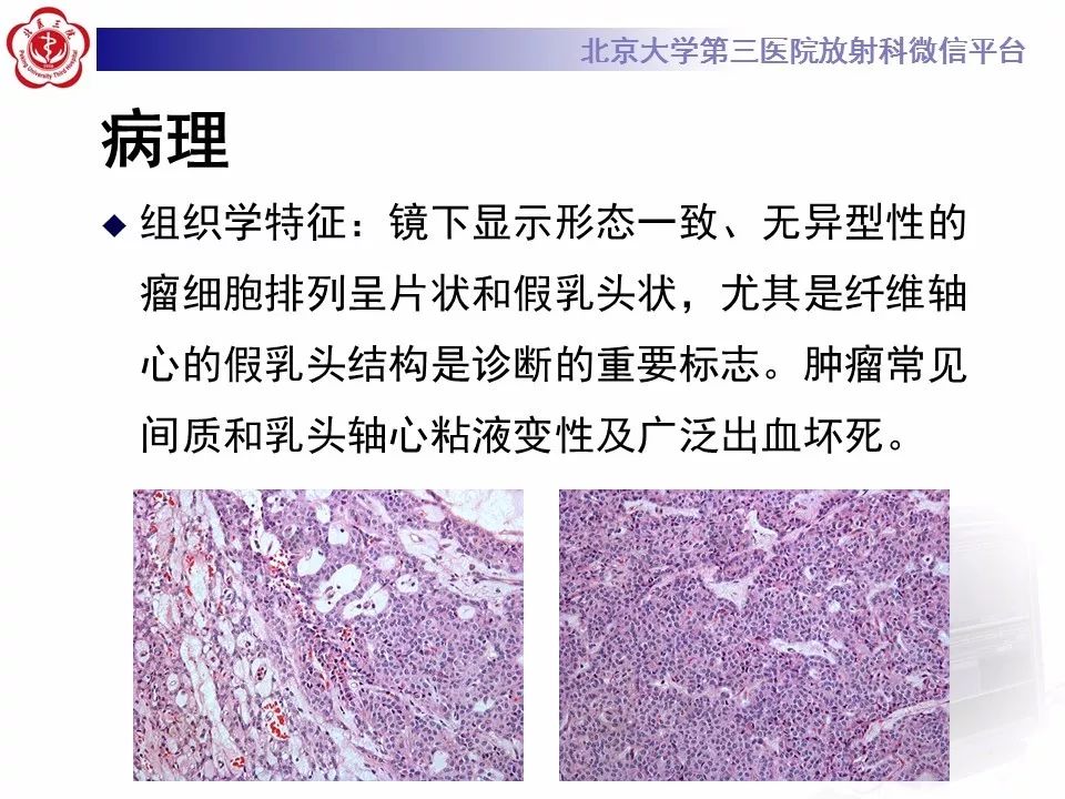 影像PPT - 【PPT】胰腺实性假乳头状肿瘤-19