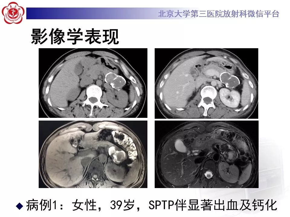 影像PPT - 【PPT】胰腺实性假乳头状肿瘤-24