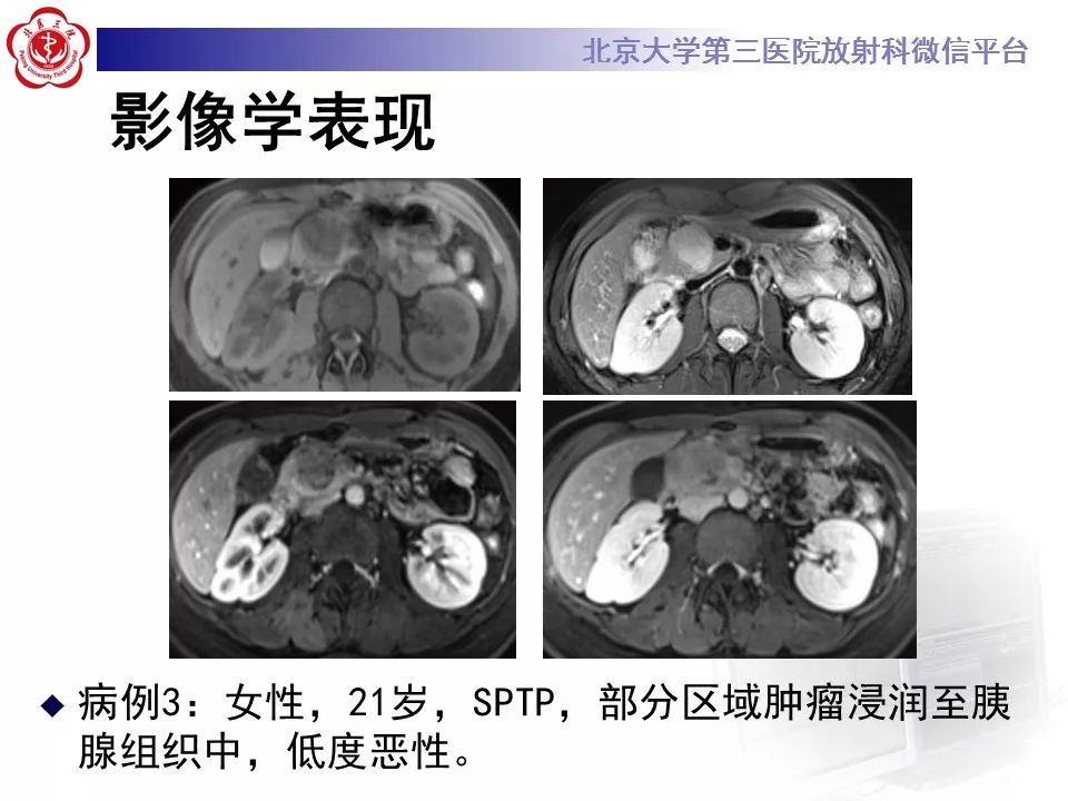 影像PPT - 【PPT】胰腺实性假乳头状肿瘤-26
