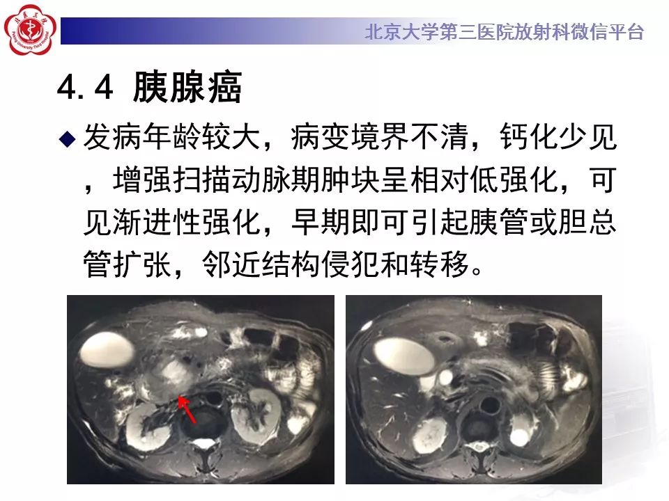 影像PPT - 【PPT】胰腺实性假乳头状肿瘤-31