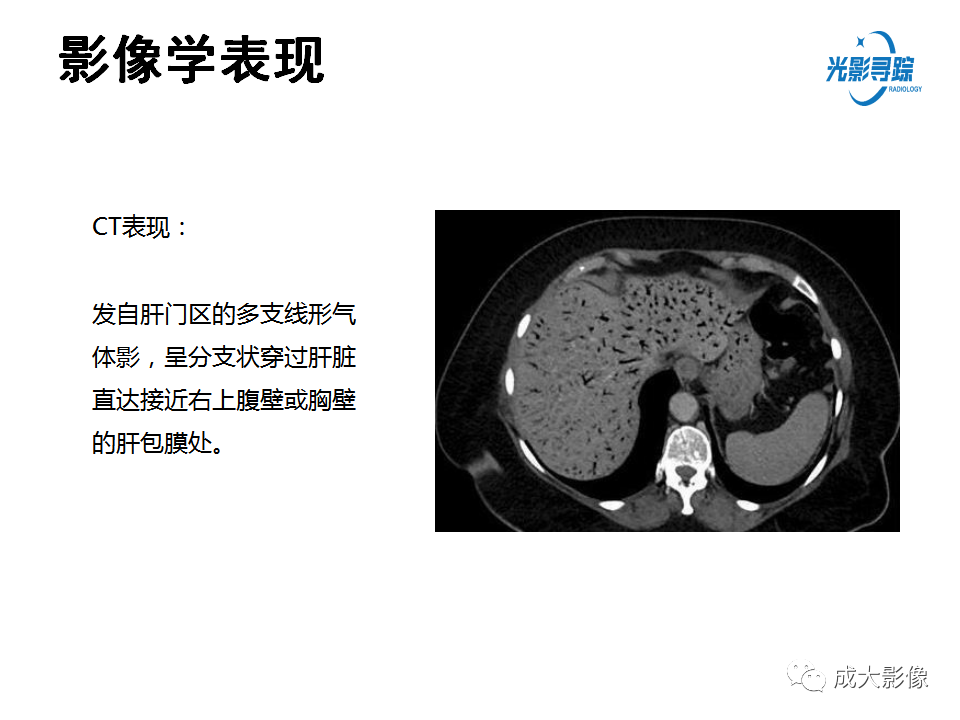 影像PPT - 【PPT】门静脉积气征-6