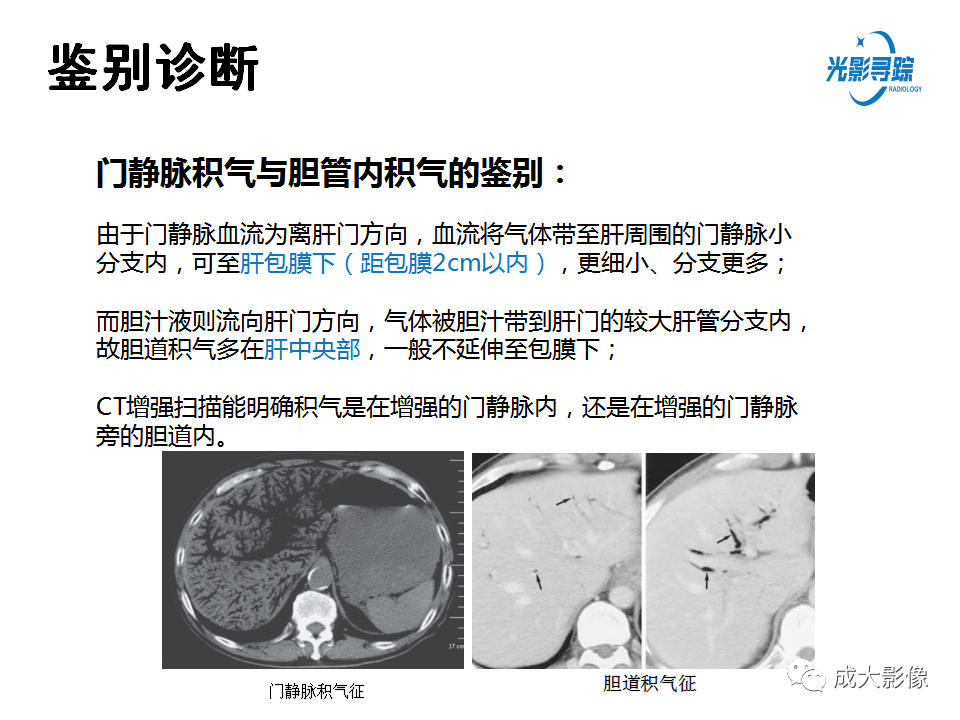 影像PPT - 【PPT】门静脉积气征-7
