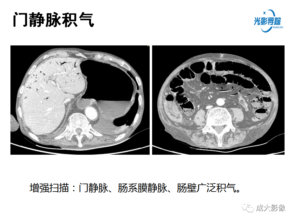 影像PPT - 【PPT】门静脉积气征-9