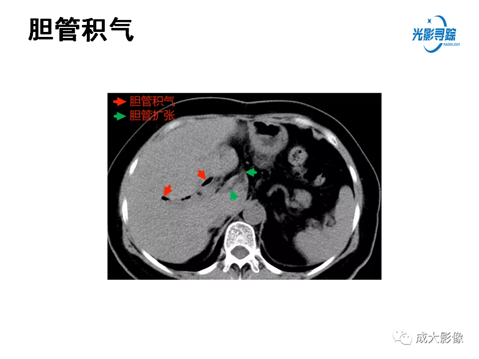 影像PPT - 【PPT】门静脉积气征-10
