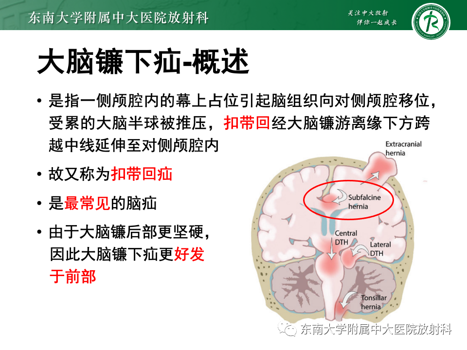 影像PPT - 【PPT】颅内疝-7