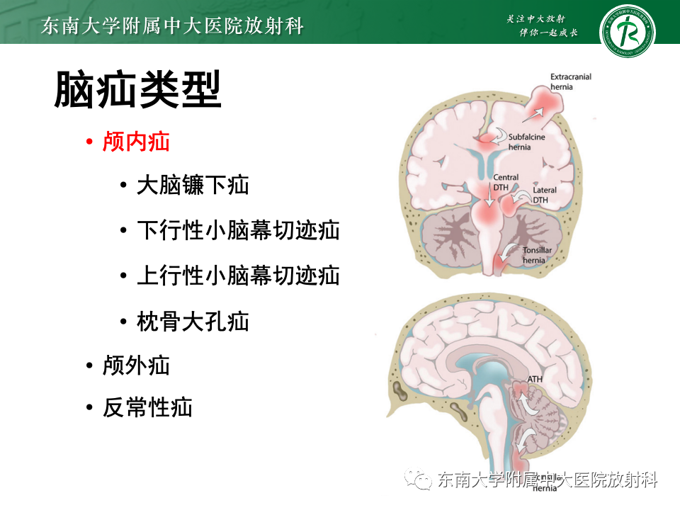 影像PPT - 【PPT】颅内疝-6
