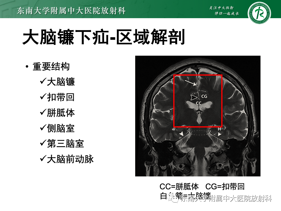 影像PPT - 【PPT】颅内疝-8