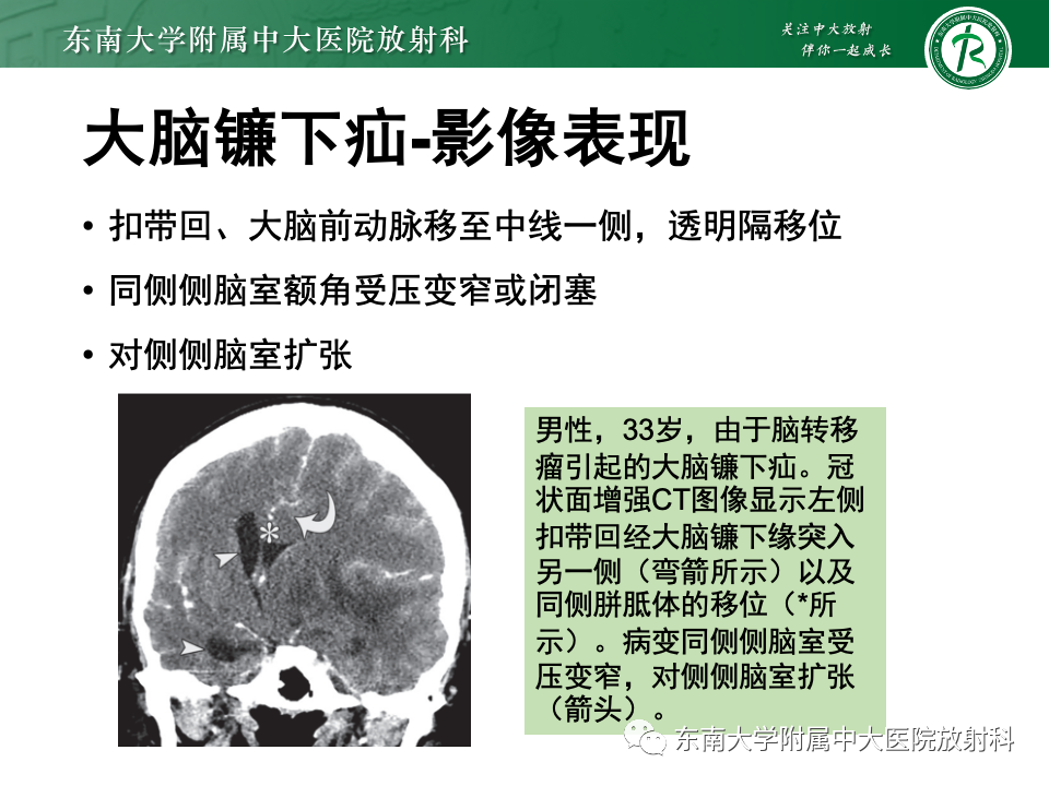 影像PPT - 【PPT】颅内疝-10