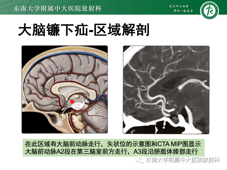 影像PPT - 【PPT】颅内疝-9