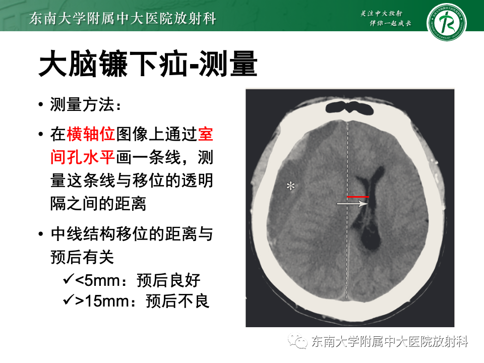 影像PPT - 【PPT】颅内疝-11
